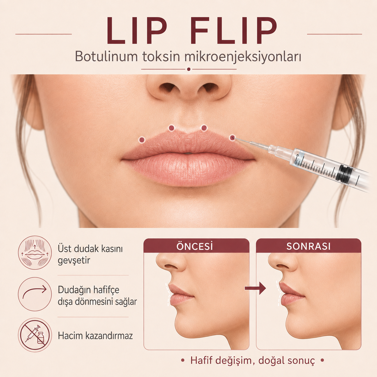 Lip flip uygulamasının çalışma prensibini gösteren illüstrasyon: dudağı aşağı çeken kasların zayıflatılmasıyla üst dudağın yukarı doğru dönmesi