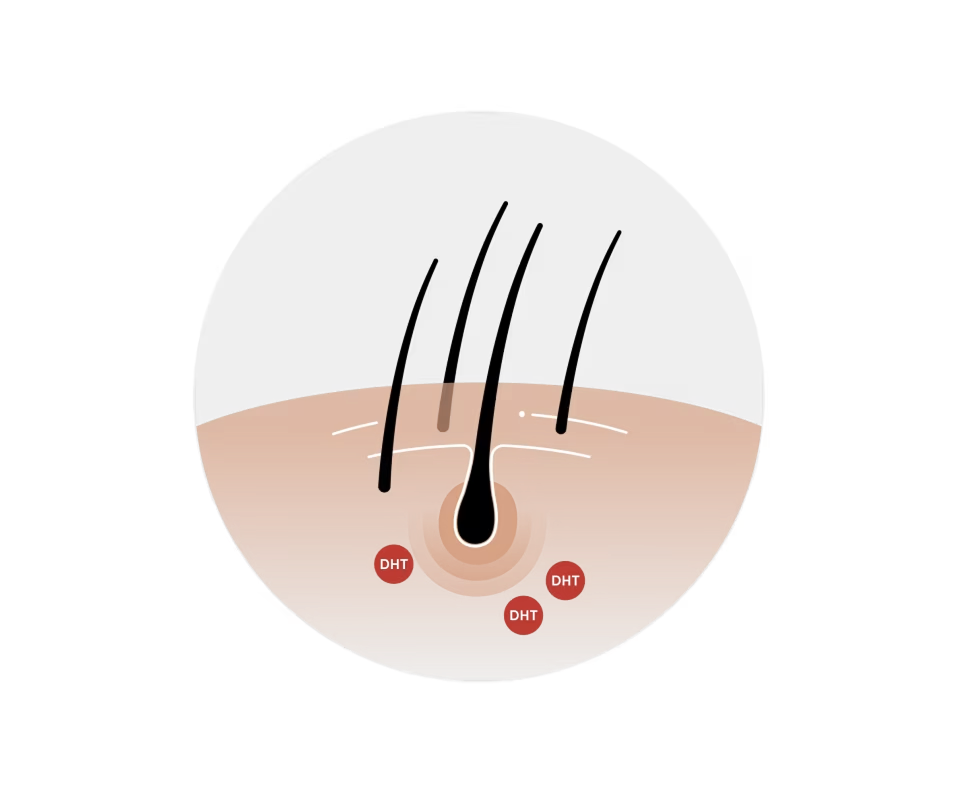 Diagram showing hair follicles with three red circles labeled DHT indicating hormone presence around the follicles on skin.