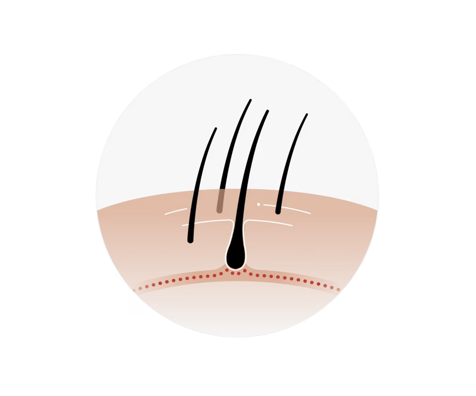 Illustration of a hair follicle under the scalp with hair strands growing from it.