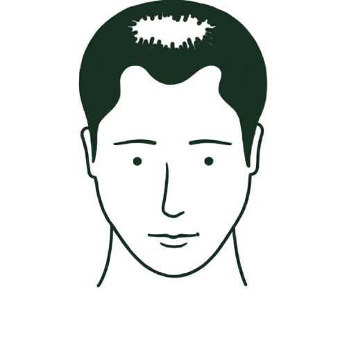 Illustration of a male head with a visible bald spot on the top of the scalp indicating hair loss.