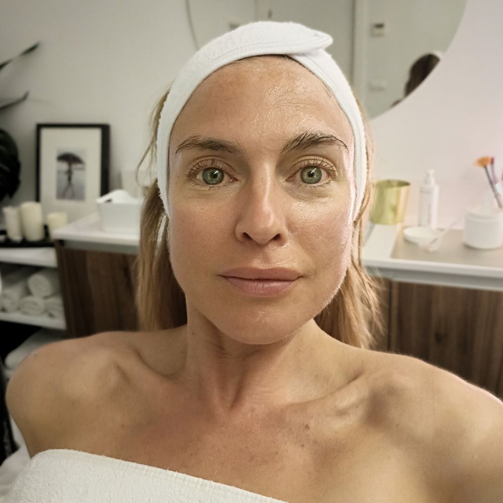 LPG Facial Perfection