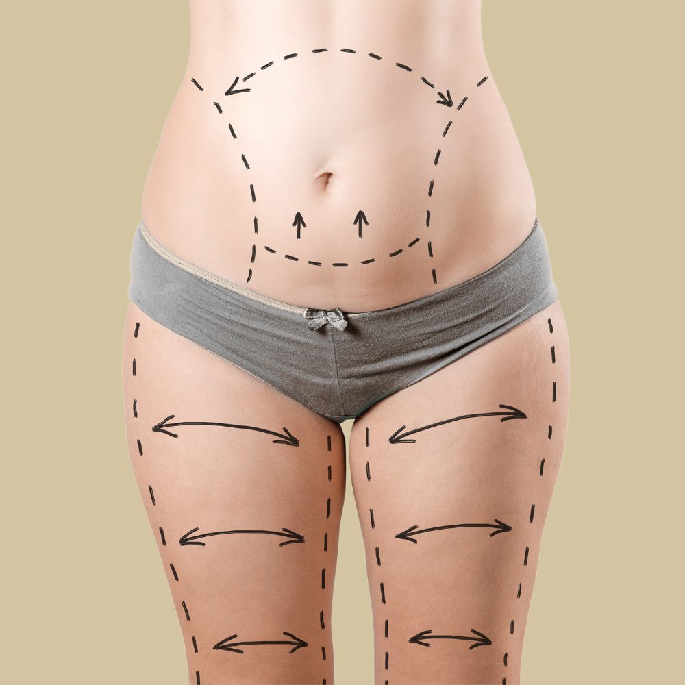 Carboxiterapia Corporal