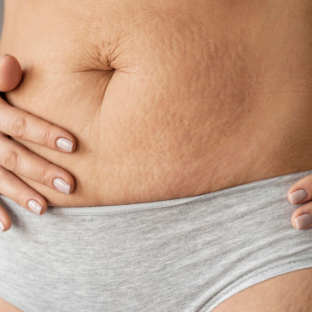 Tratamiento de Estrías