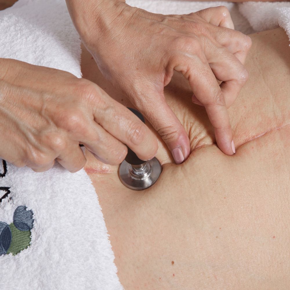 Cicatrices Recientes INDIBA