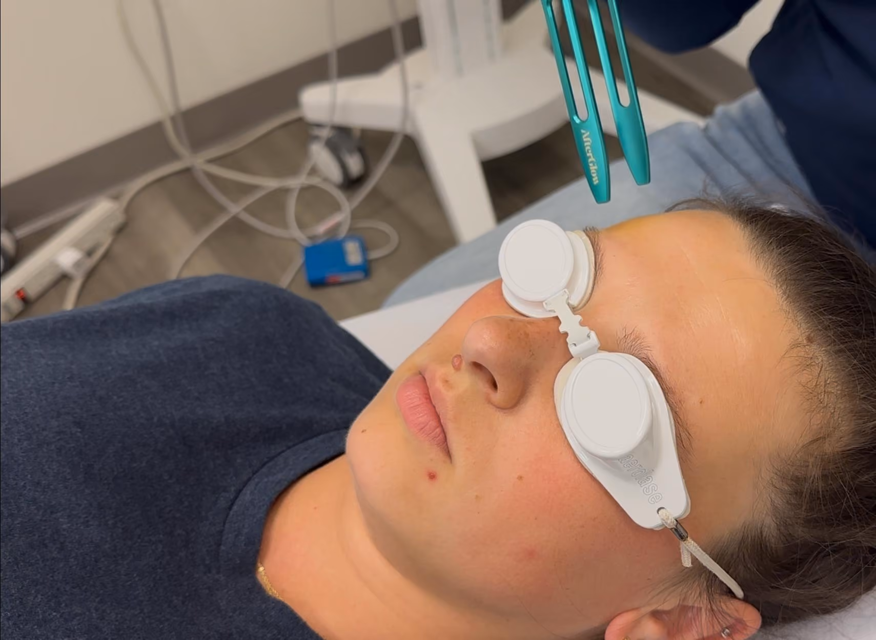 Treating a patient with the Aerolase Era with the variable AfterGlow lens