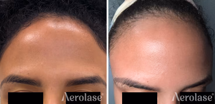 Forehead before and after an Aerolase Era AfterGlow lens