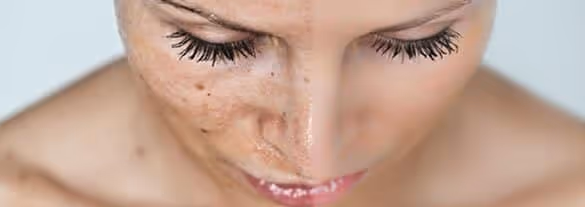 Things to consider when treating melasma