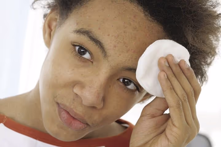 Acne affects people of all ages