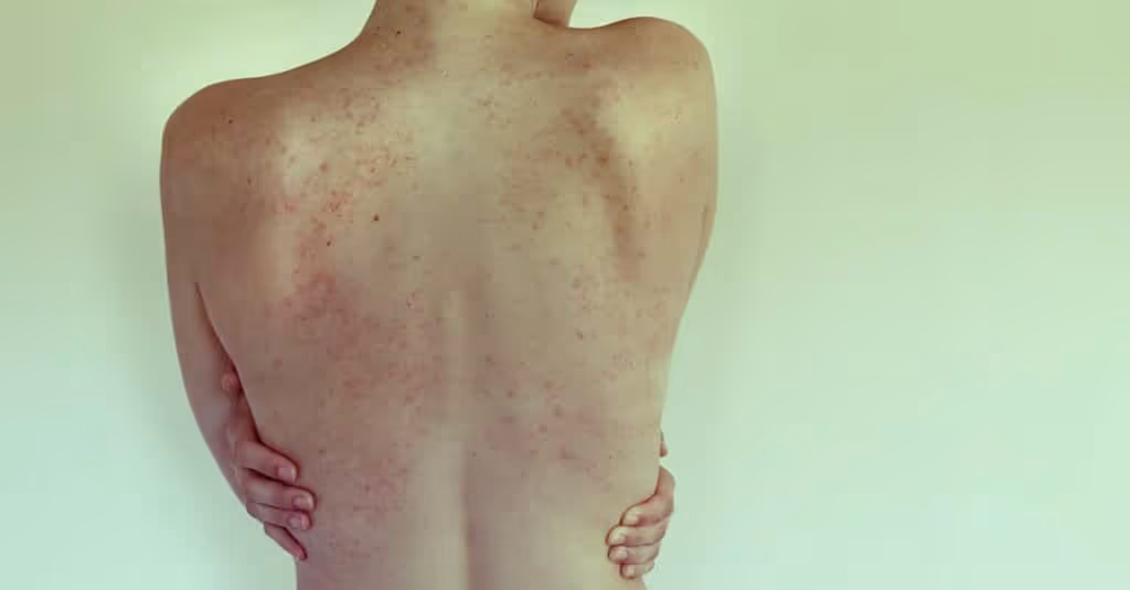 The stubborn, autoimmune skin condition of psoriasis