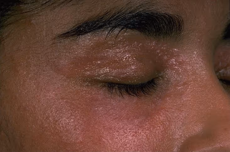 How to identify rosacea in skin of color patients
