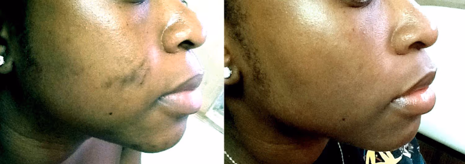 skin of color patient with scar on face before and after