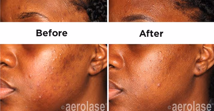 Dr. Henry says the treatment is safe and relatively pain-free on all skin types. It works well for hyperpigmentation and acne as well as ingrown hairs (which can lead to hyperpigmentation). Treatments range from $400 to $600.The above photo is from Dr. Henry's practice, Laser & Skin Surgery Center of New York.
