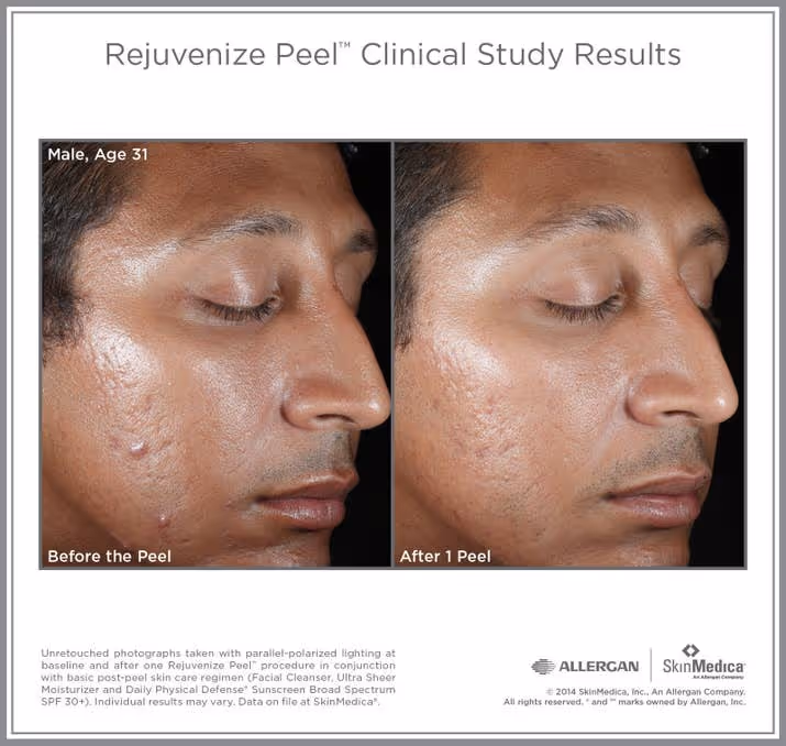 Dr. Henry recommends three to six treatments for significant results, and they range from $200 to $300.