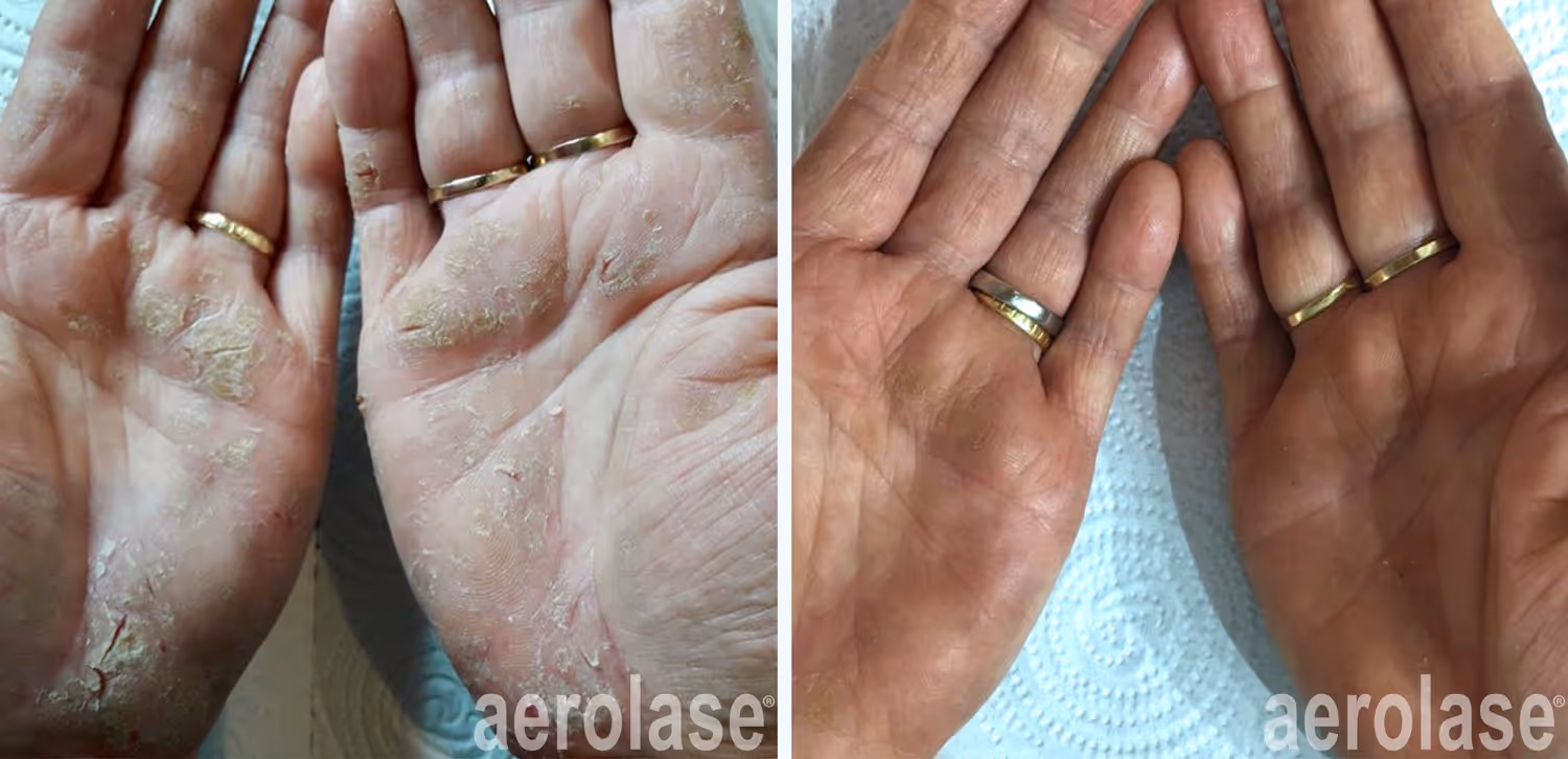 before and after psoriasis laser treatment with the neo elite