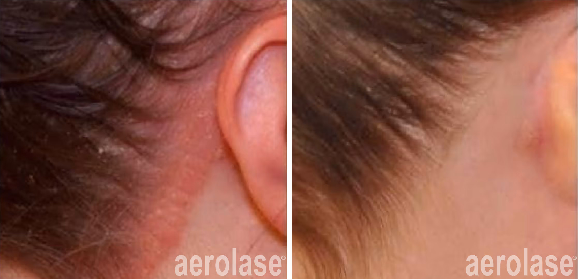 scalp psoriasis treatment with the Exci308