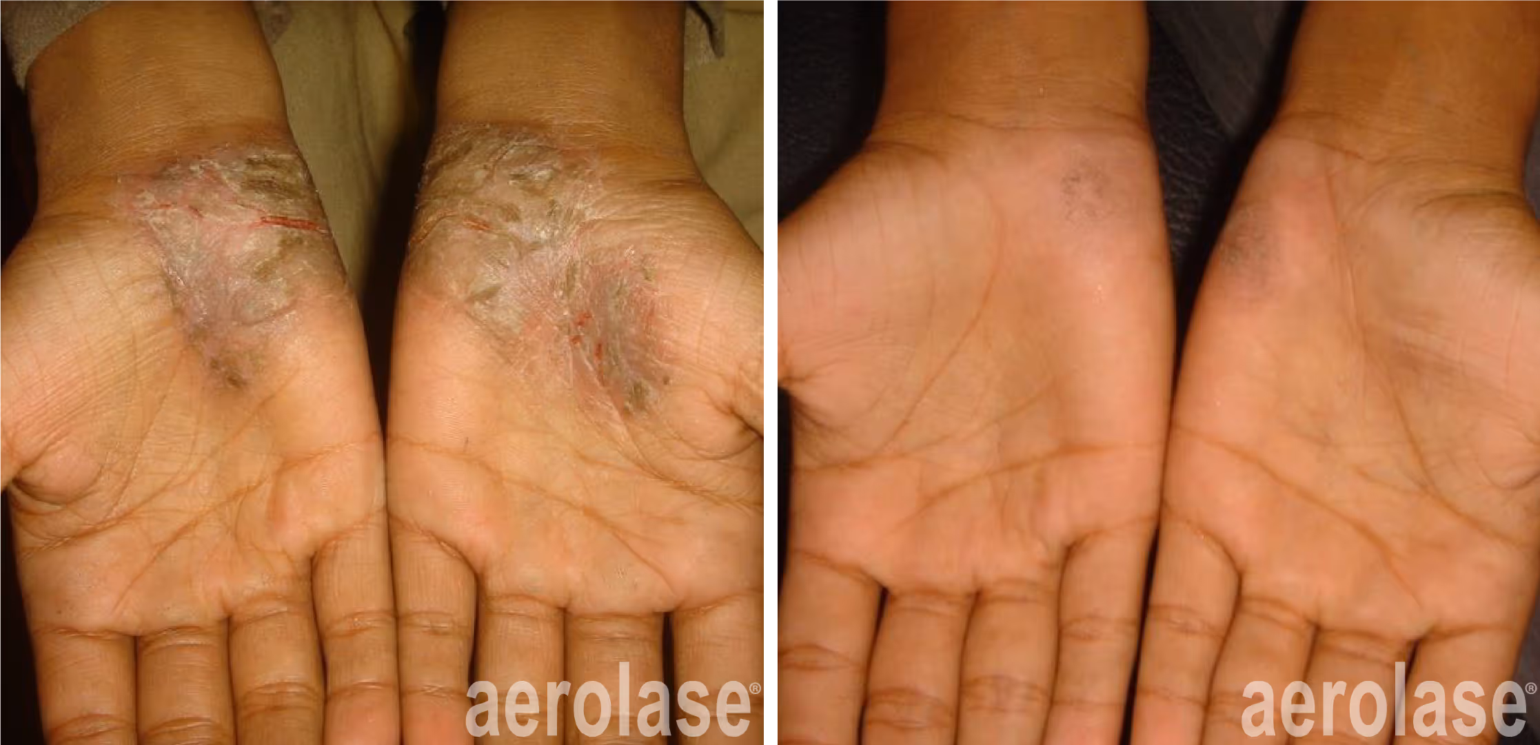 palmo plantar psoriasis before and after treatment with the Exci308