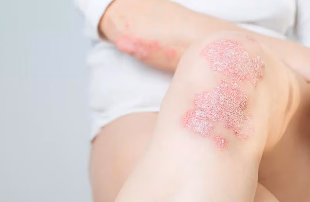 Exci308 by Aerolase Phototherapy for Psoriasis Autoimmune Diseases