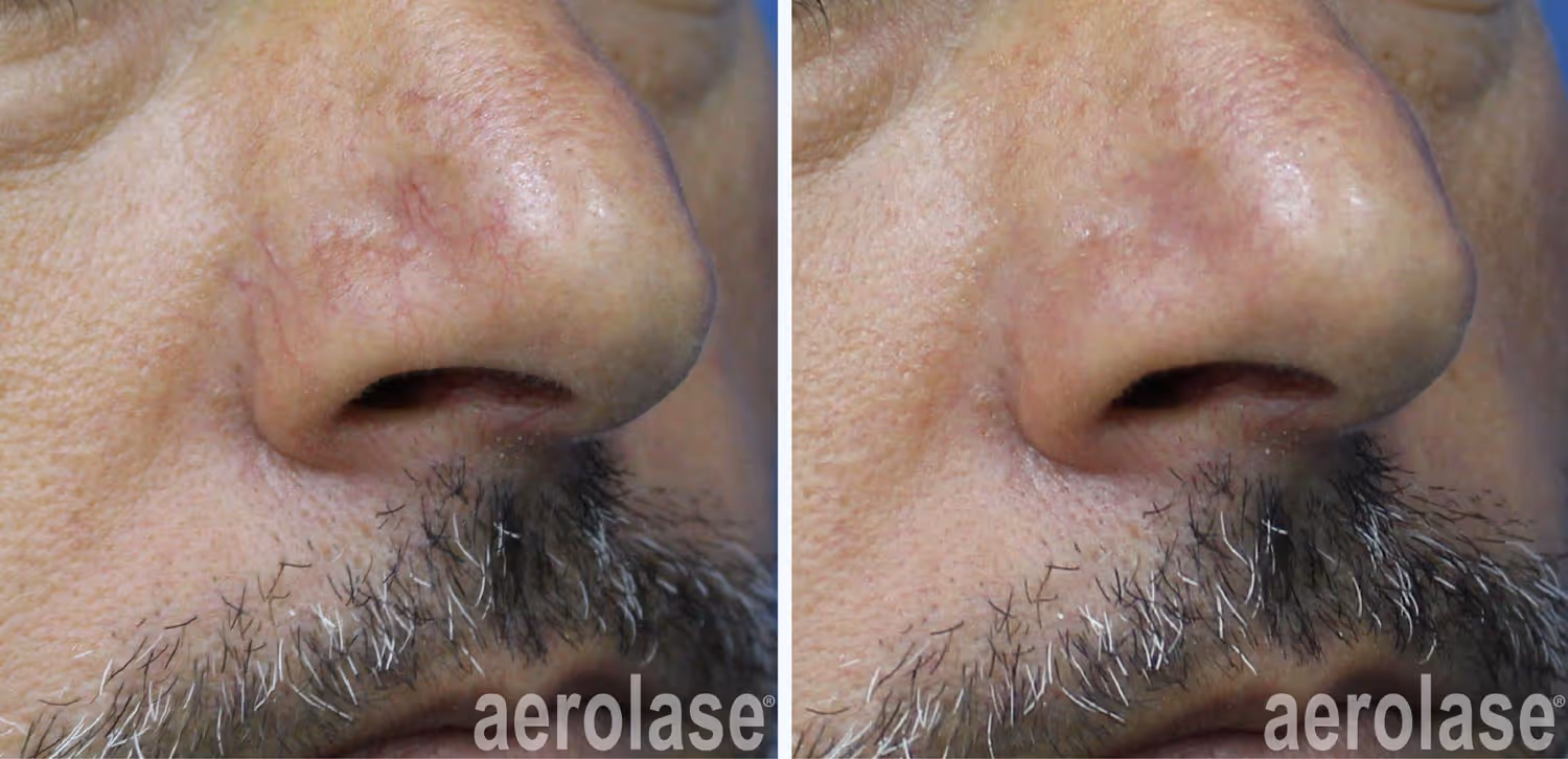 facial veins after neo elite laser treatment