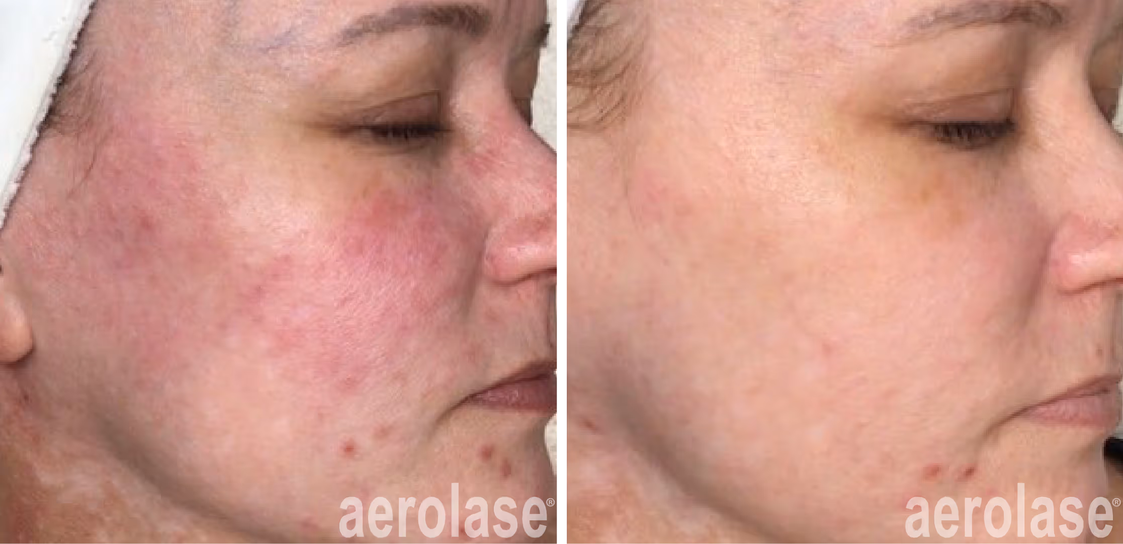 rosacea after neo elite laser treatment