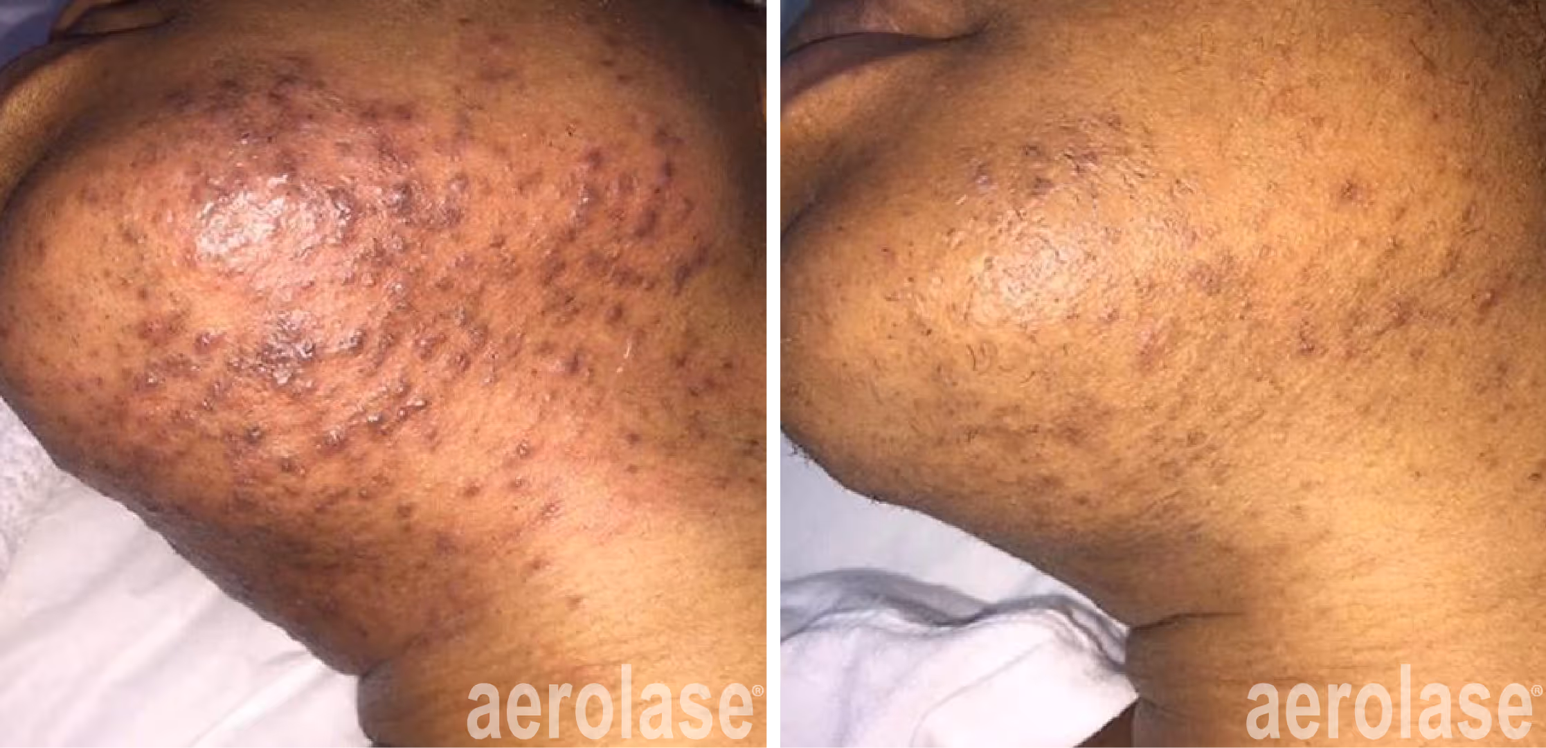 before and after neo elite laser treatment of pfb