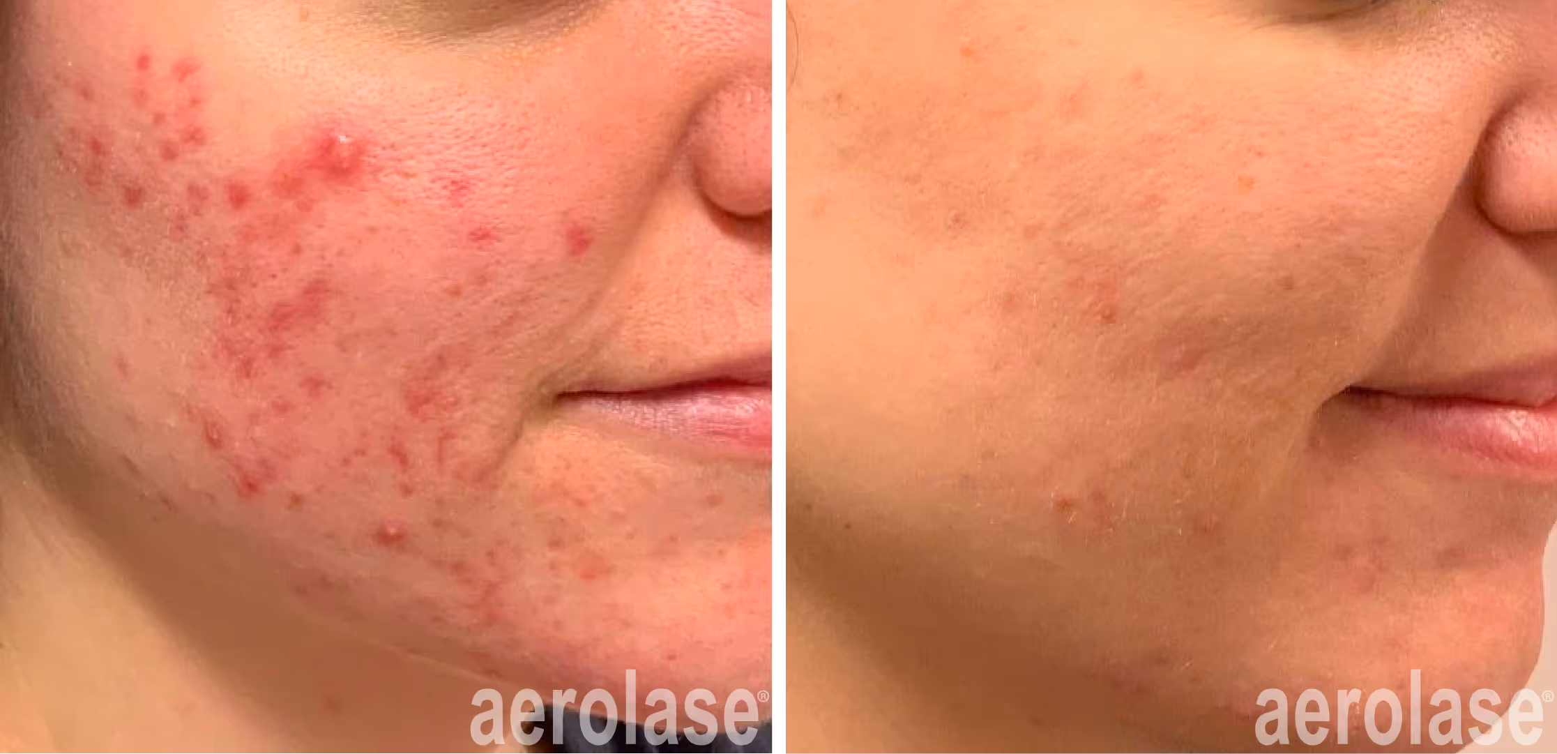 acne after laser treatment with the Neo Elite