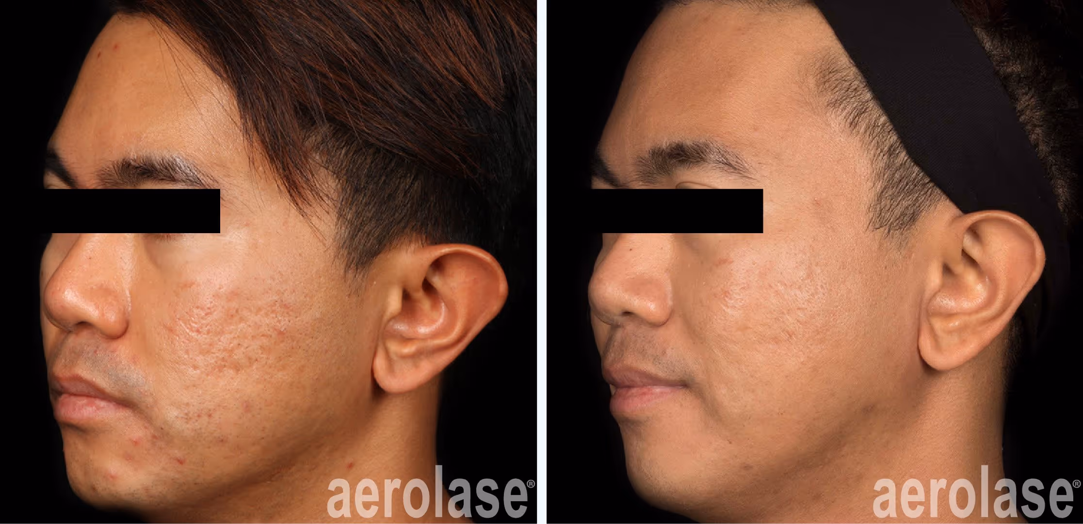 before and after laser treatment of an asian patient with acne scars