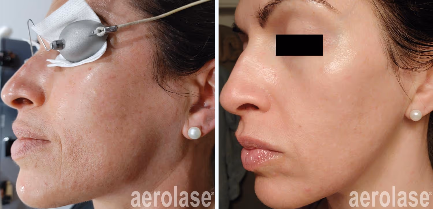 before and after laser treatment of face wrinkles