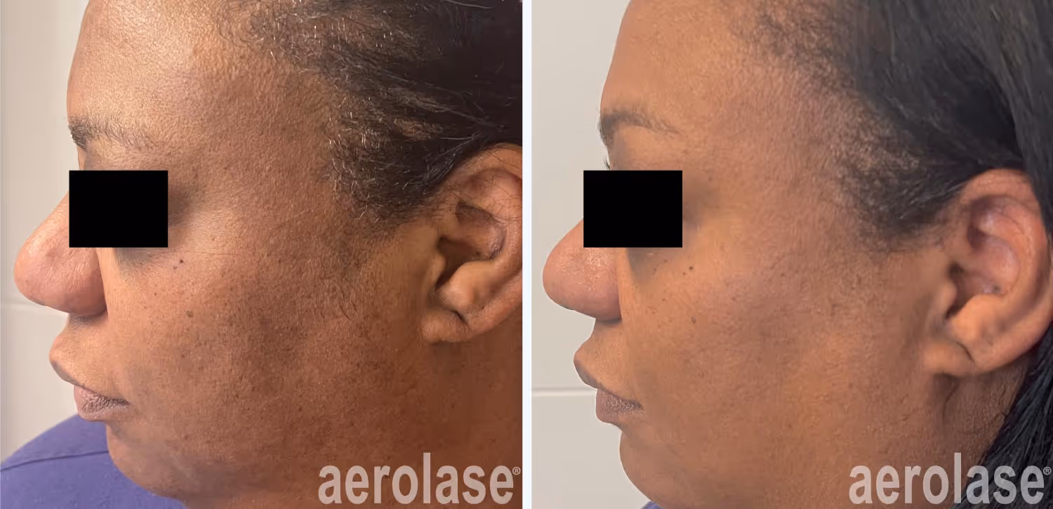 before and after laser treatment on a skin of color patient