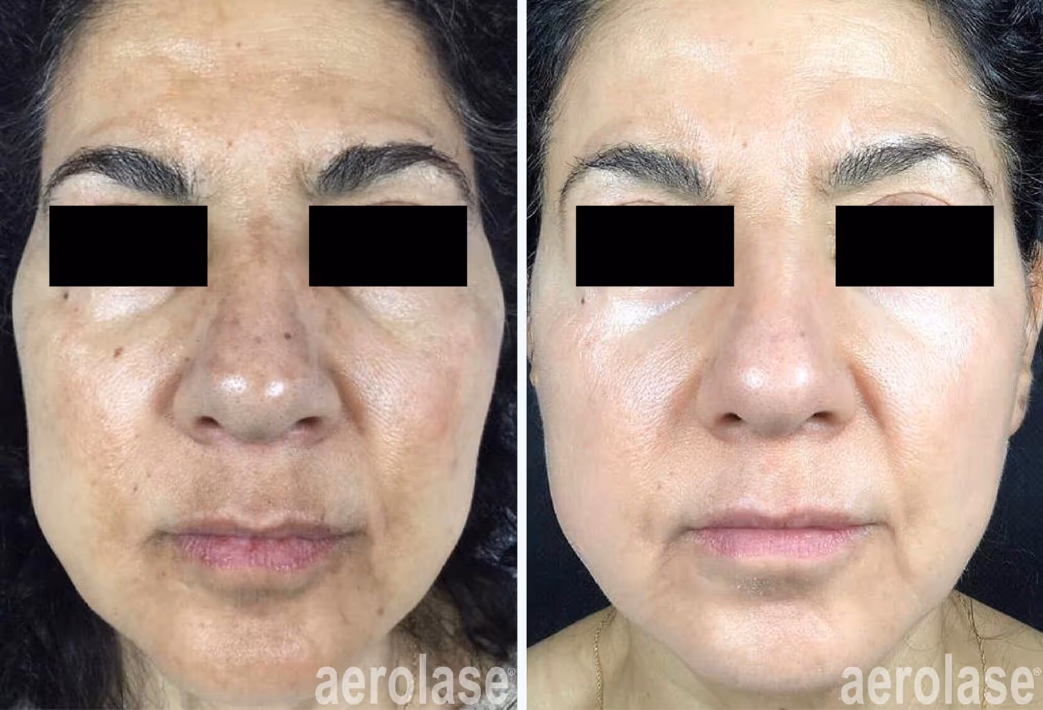 before and after laser treatment of hyperpigmentation
