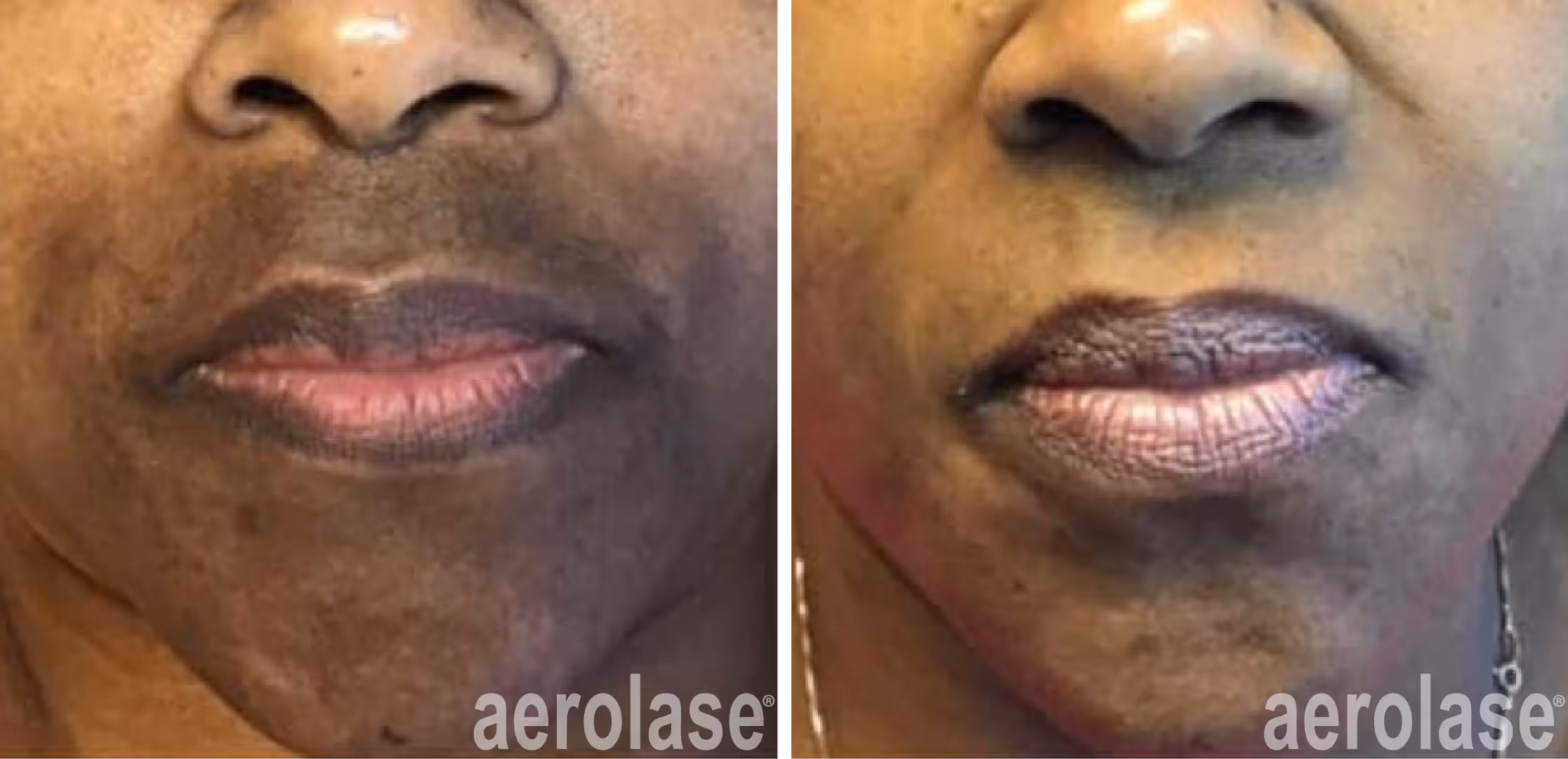 melasma before and after neo elite laser treatment