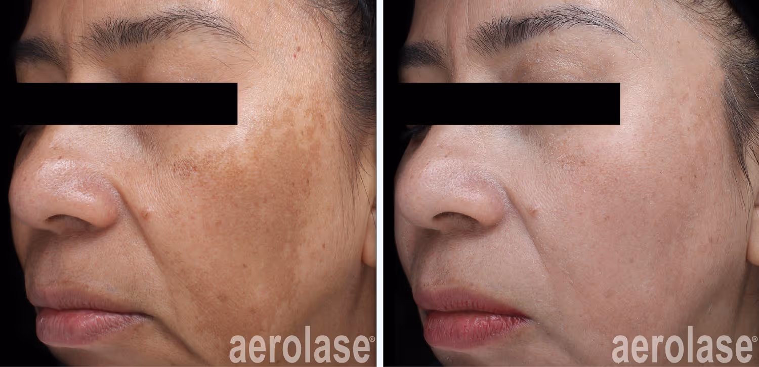 before and after neo elite laser treatment of melasma