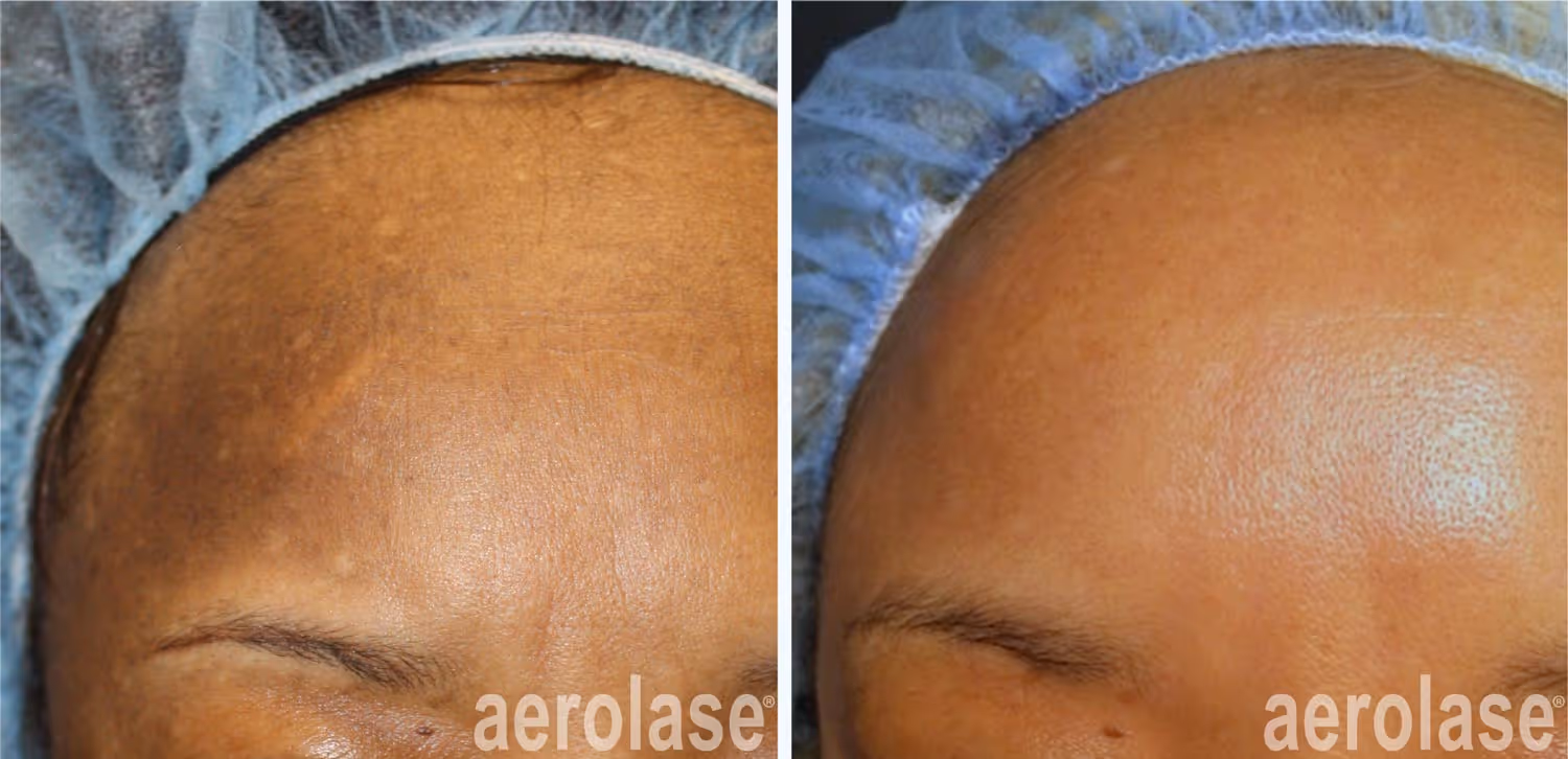 Aerolase Melasma Hyperpigmentation Treatment