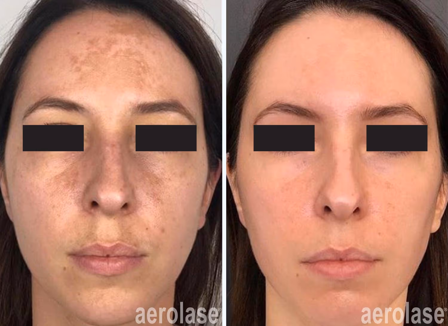 laser treatment of melasma before and after by the aerolase neo elite