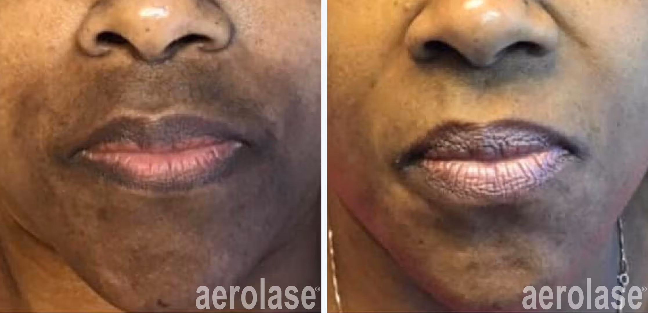 hyperpigmentation or melasma before and after laser treatment