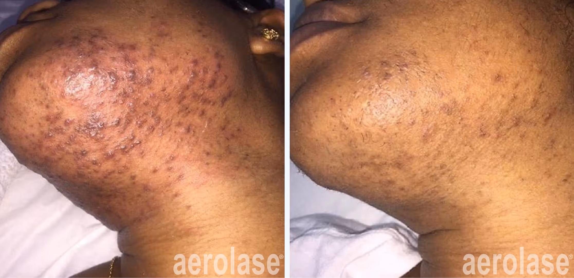 acne and pfb before and after laser treatment