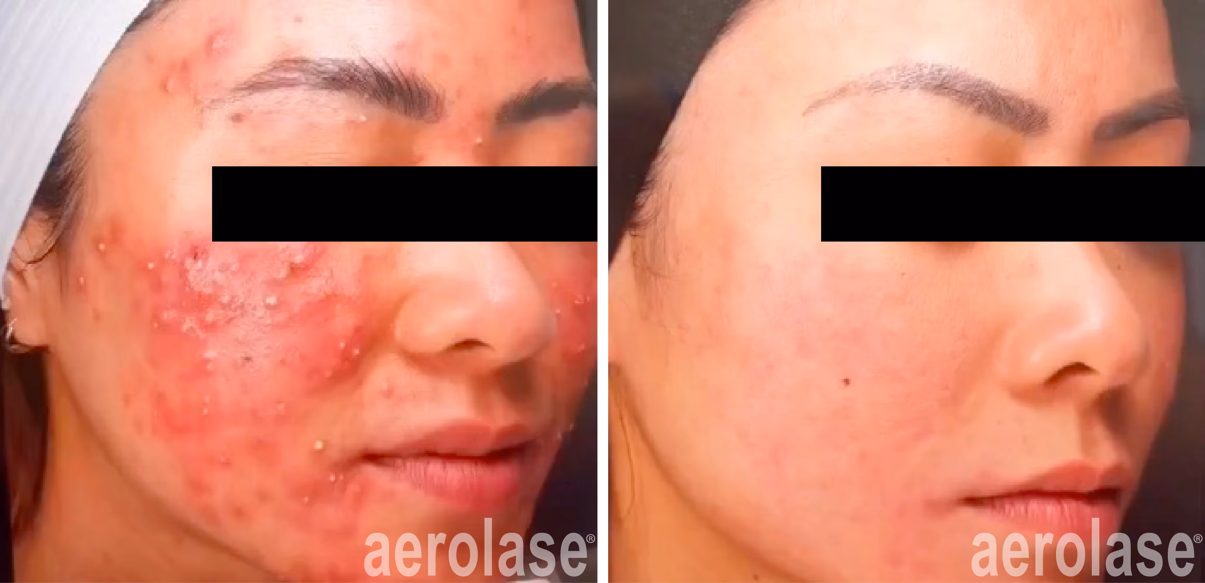 before and after combination treatment of acne with neo elite followed up with a chemical peel