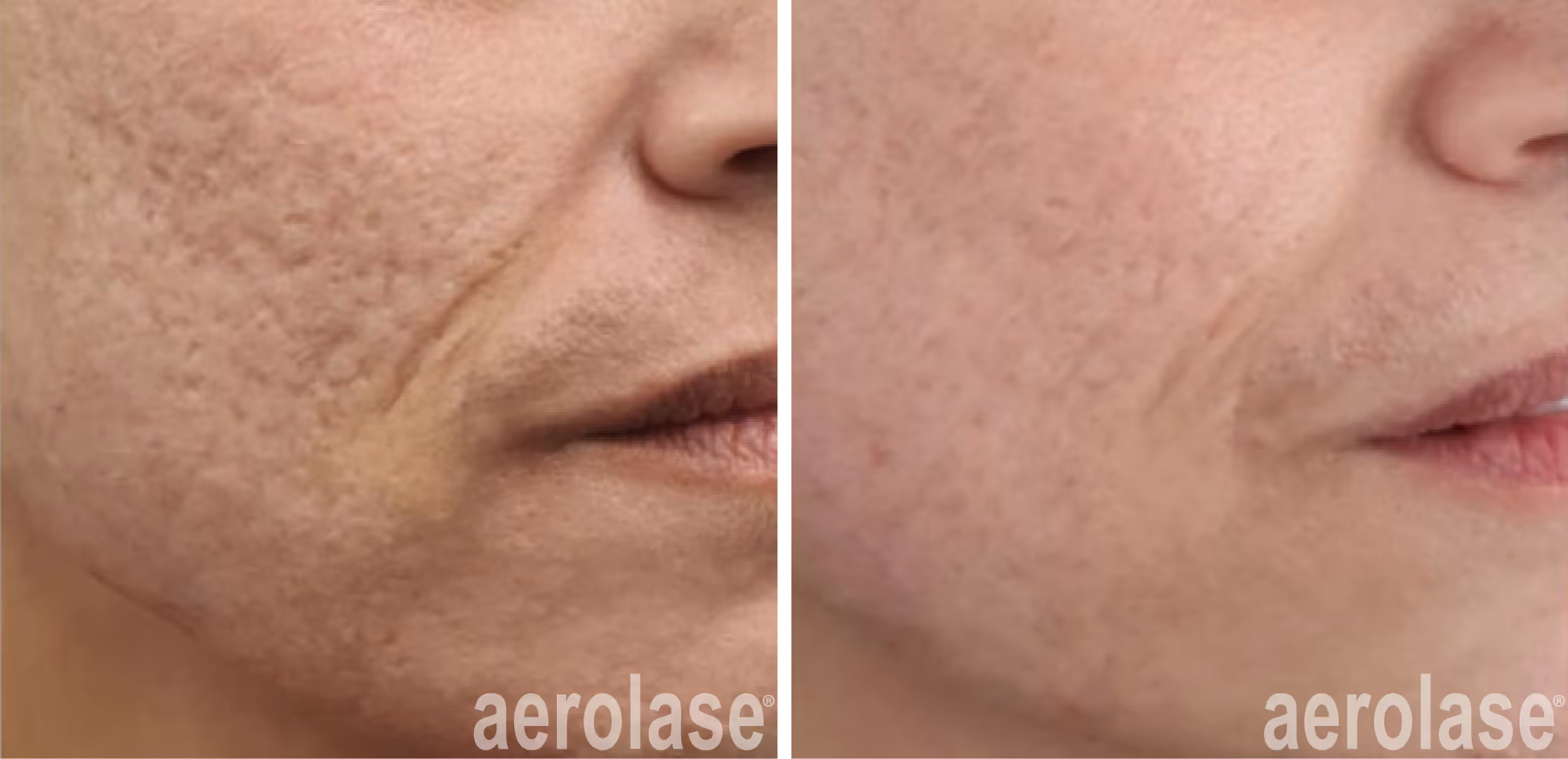 acne scars before and after treatment with the neo elite and era elite