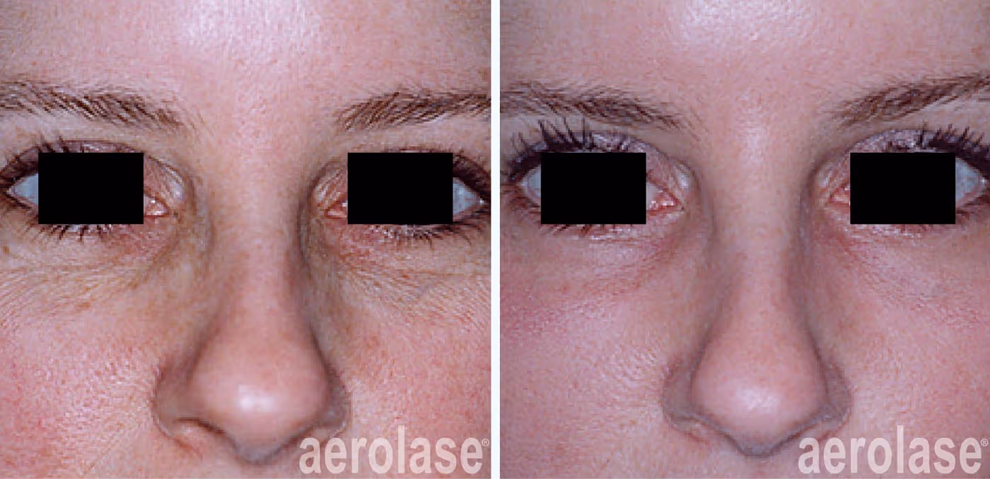 Aerolase Wrinkles and Crows Feet James Gordon