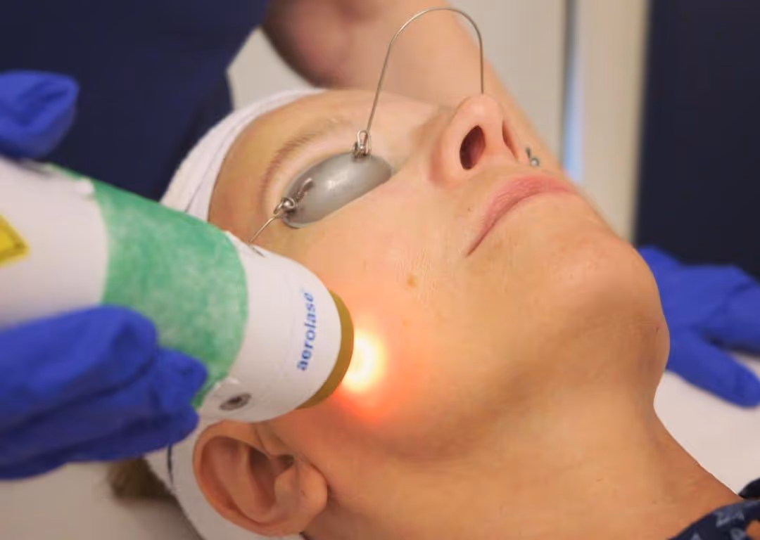 Neo Elite Aerolase Treatment by SafiraMD