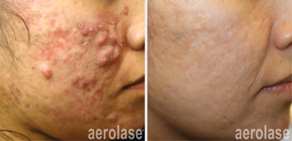 Aerolase Michael Gold Neo Elite Acne Treatment