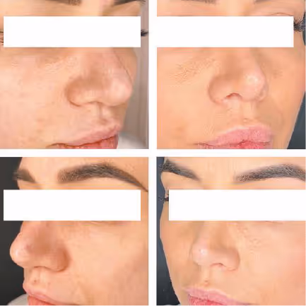 aerolase laser treatment after rhinoplasty