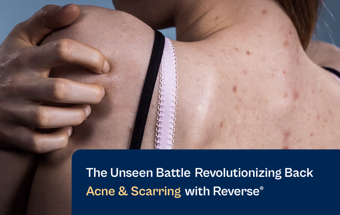 Treat Back Acne and Scarring with Reverse by Aerolase Blog