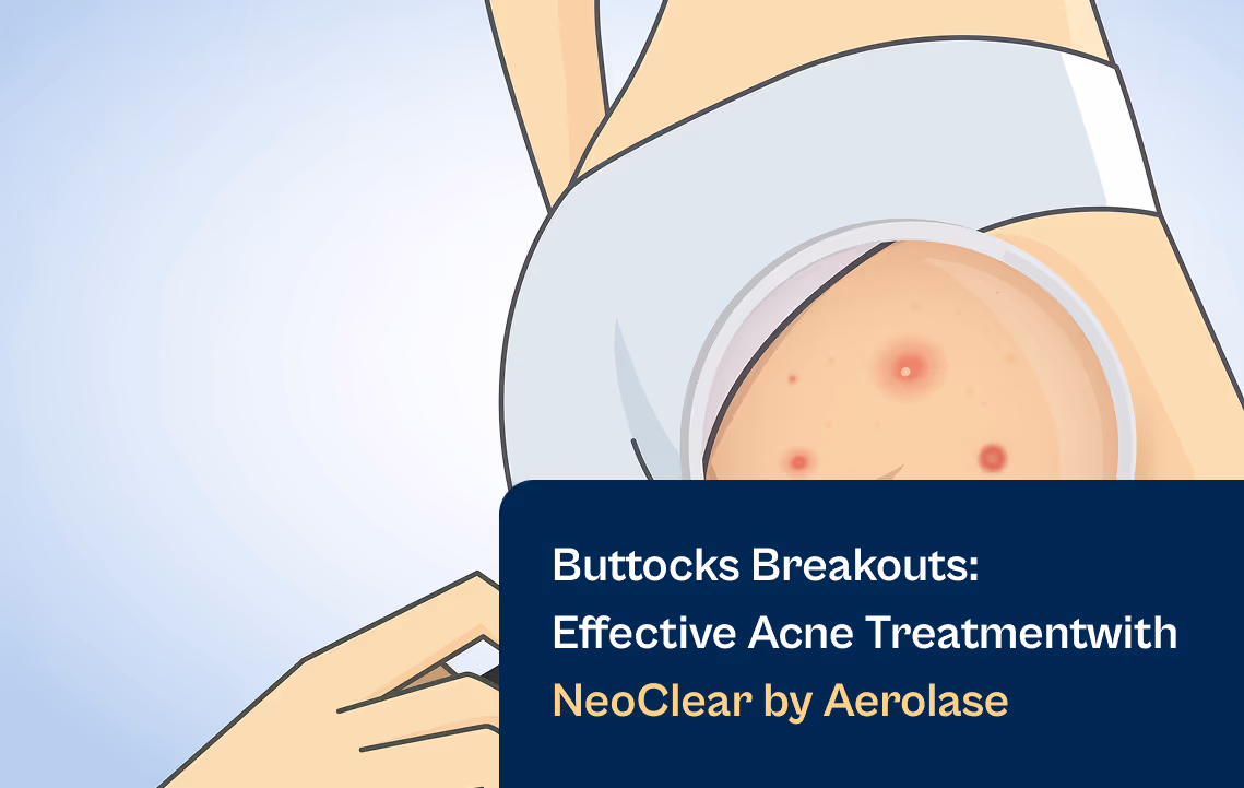 Buttocks acne breakouts laser treatment