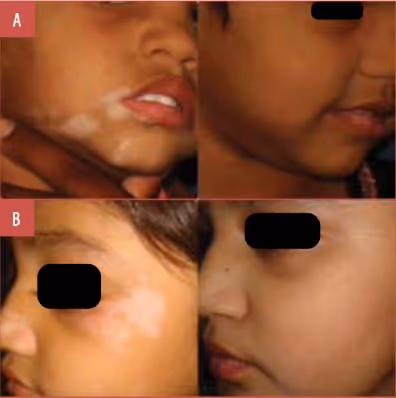before and after vitiligo treatment