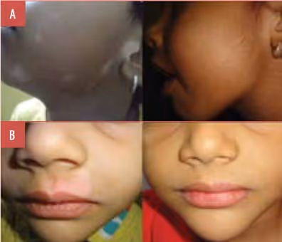 child with vitiligo before and after excimer treatment