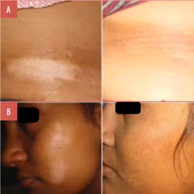 vitiligo before and after excimer lamp treatment