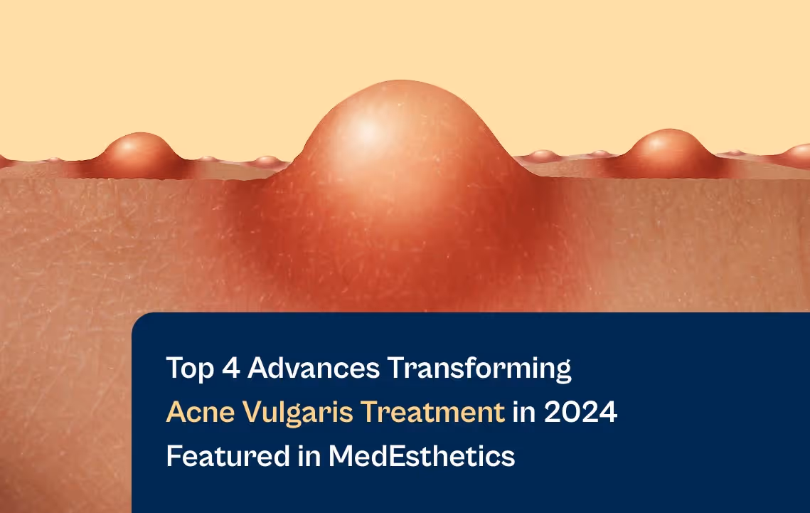 Aerolase top 4 advances transforming acne vulgaris treatment in 2024