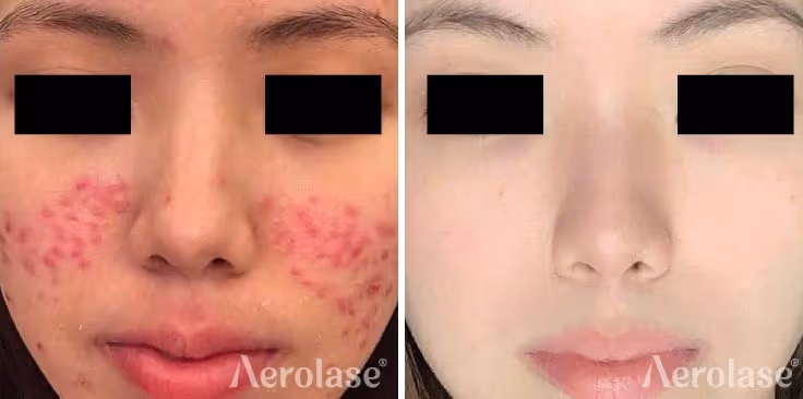 acne