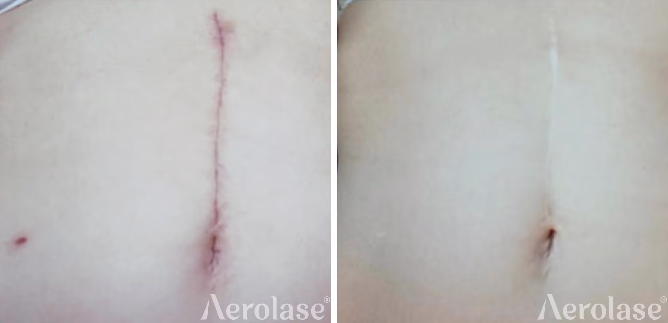 post-surgical scars treated with the Aerolase Neo