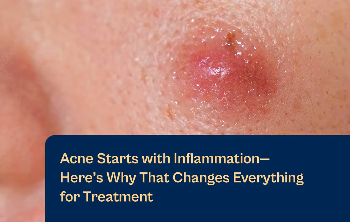 Acne starts with inflammation and here are reasons why that changes everything for treatment Aerolase blog